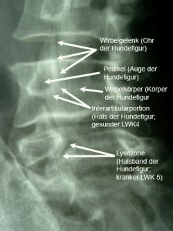 (aus reiser, kuhn, debus, duale reihe radiologie, thieme, 2017). Diagnose einer Spondylolisthesis