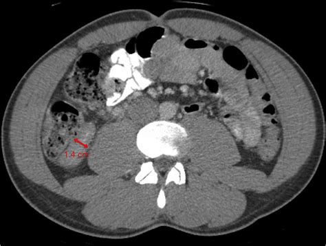 Abdominal Ct Performed With Oral And Iv Contrast Appendix Is Dilated