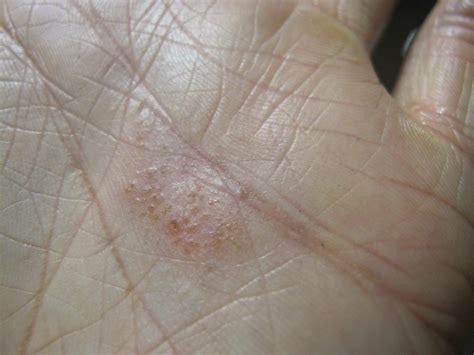 Dyshidrotic Eczema Hand Rash Flickr Photo Sharing
