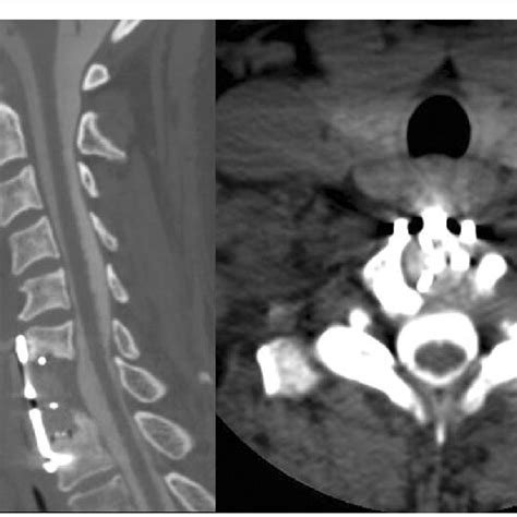 Preoperative Magnetic Resonance Imaging Of The Cervical Spineleft
