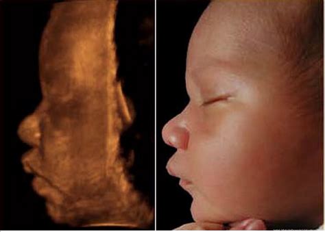 One two two weeks before the appointment, start drinking a lot of fluid so you can clear. Gallery: Breathtaking 3D Ultrasound Before & Afters! | 3d ...