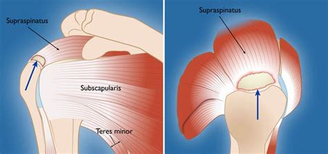 Rotator Cuff Tears Surgical Treatment Options Orthoinfo Aaos