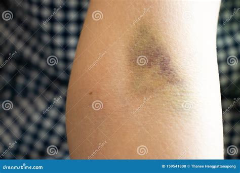 Bruise Injury On The Female Arm Background Stock Photo Image Of