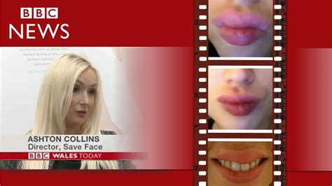 Bbc News The Risks Of Lip Fillers In Unsafe Hands Youtube