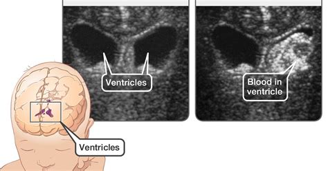 Intraventricular Hemorrhage Ultrasound