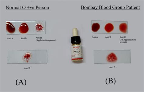 View Blood Type A Agglutination Background Blood Type