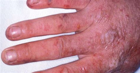 Rare Skin Diseases