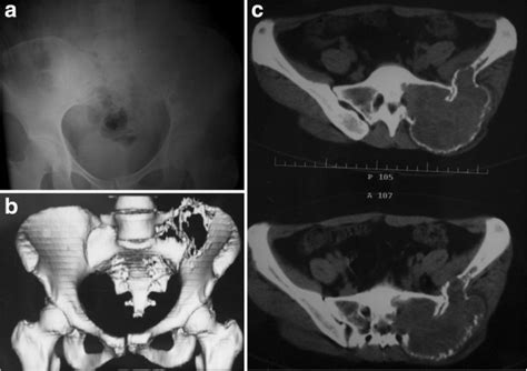 A Year Old Woman Presented With Giant Cell Tumor Involving Left