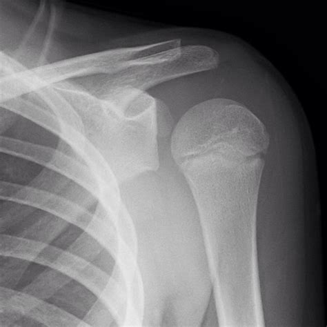 Radiology Signs Posterior Shoulder Dislocation In A Child With