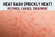 Heat Rash: Pictures, Symptoms, Causes, Types, and Treatment