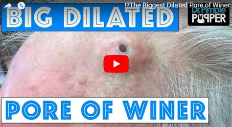 The Biggest Dilated Pore Of Winer Dr Pimple Popper