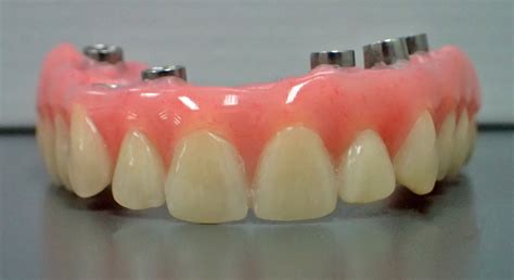 Fixed Implant Retained Hybrid Dentures Burnham Denture Clinic In
