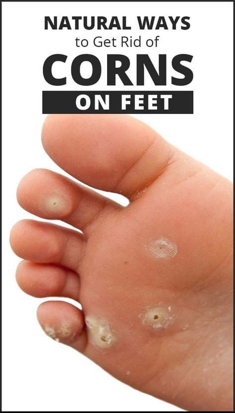Home Remedies For Corns On Feet With Images Get Rid Of Corns Foot