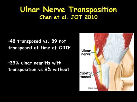 Right Ulnar Nerve Transposition Surgery