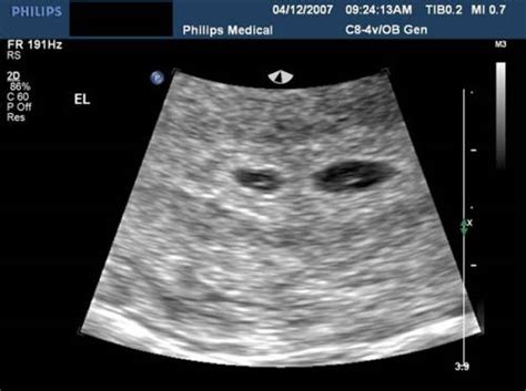 4 Week Twin Ultrasound