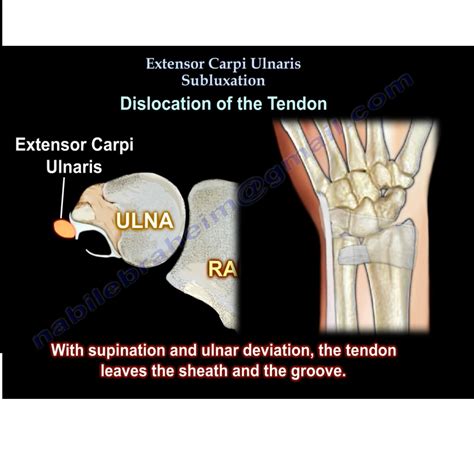 Extensor Carpi Ulnaris Subluxation Orthopaedicprinciples Com