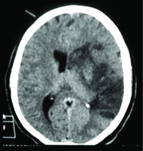 Initial Non Contrast Ct Scan Of The Head Shows The Large Left Cerebral