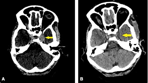 Cavernous Sinus Thrombosis A Late Complication Of Head And Neck