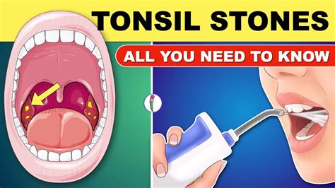 Tonsil Stones Tonsil Stones Treatment Tonsil Stone Removal All