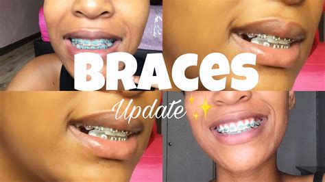 Braces Update What To Expect Youtube