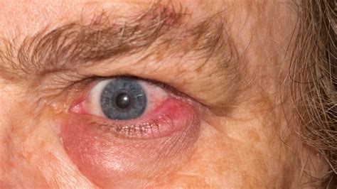 Infected Eye Types Causes And Treatment D