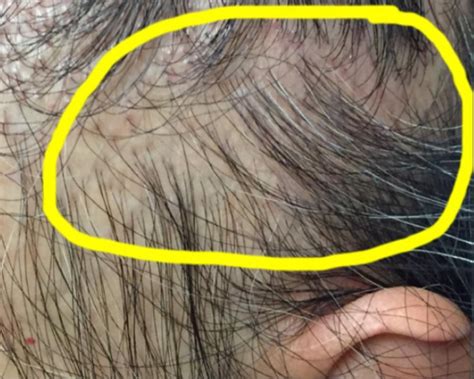 hair loss in women — donovan hair clinic