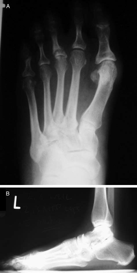 Treatment Of Hammertoe Deformity Using A One Piece Intramedullary