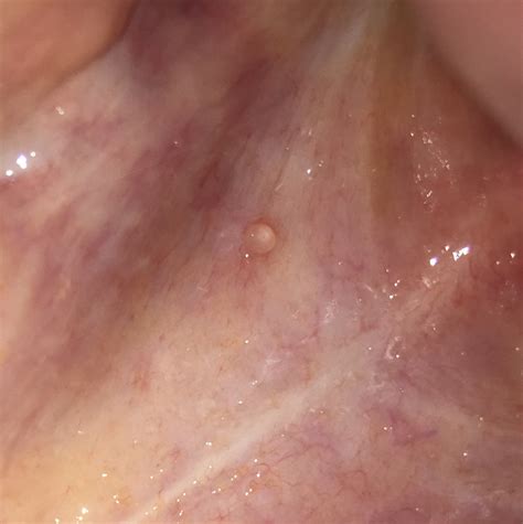 In this return, your body gives in to any kind of infection that may even appear not to be that serious. Weird bump? Please help. It does not hurt I just don't ...