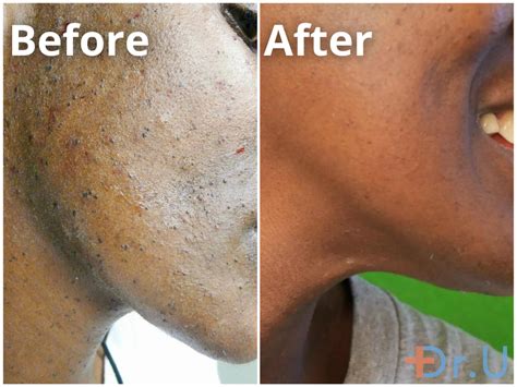 Dermatosis Papulosa Nigra Removal Before And After