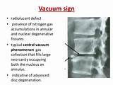 Vacuum Disc Phenomenon Pictures