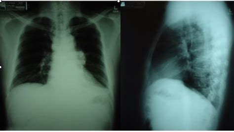 Supraclavicular Lymph Nodes Location Function And Pictures