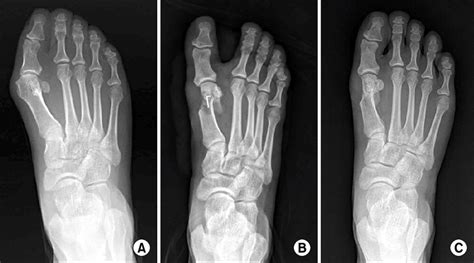 The Right Foot Of 46 Year Old Female Shows Moderate Hallux Valgus