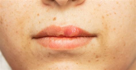 Understanding And Eliminating Fever Blisters Stop Cold Sores