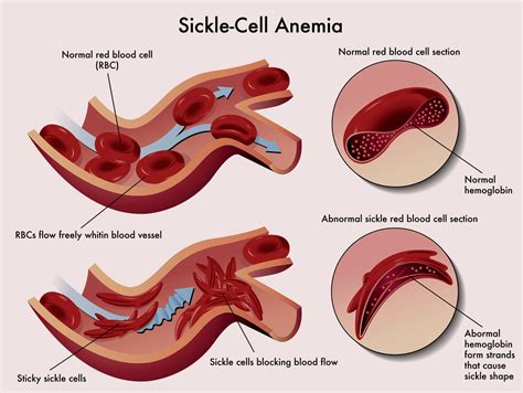 Treat Cure Sickle Cell Anemia Naturally With Body Oxygen And Breath
