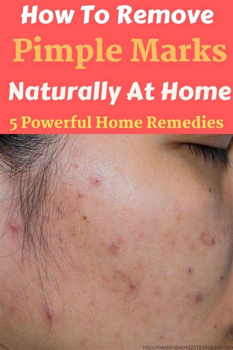 How To Remove Pimple Marks Naturally At Home 5 Powerful Home Remedies