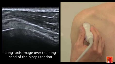 Ultrasound Of The Shoulder I Youtube