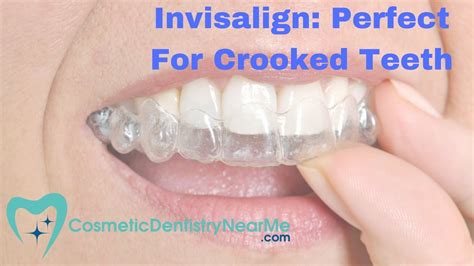 Invisalign Perfect For Crooked Teeth Youtube