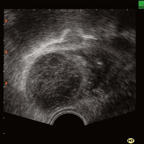 Transvaginal Sonogram Showing A Hemorrhagic Corpus Luteal Cyst With