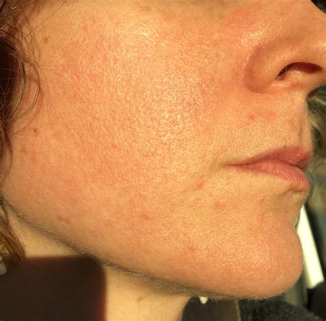 Rosacea Or Burn Derm Says A Retinol Product Triggered Rosacea In My
