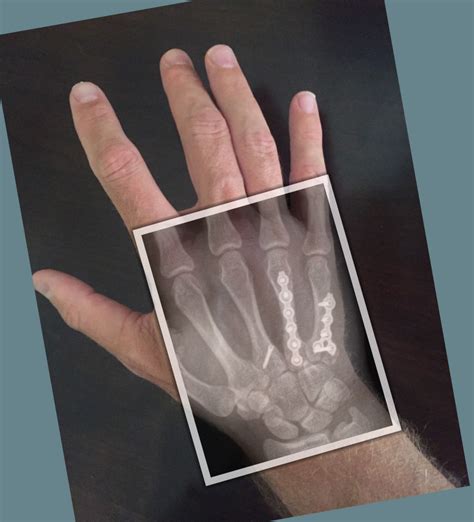 Metacarpal Fracture Treatment In Raleigh Nc By Dr Erickson