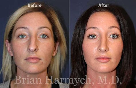 Rhinoplasty Nose Job Before And After Ohio