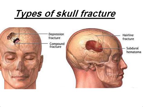 Fraktur avulsi adalah fraktur yang terjadi ketika sebuah bagian tulang dari tulang utama di daerah sambungan ligamen ke sendi patah. Fraktur Depresi Adalah : Fraktur Impresi Depresi ...