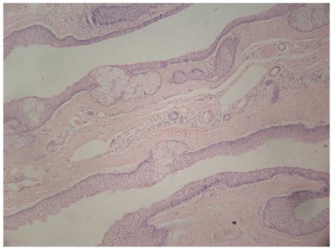 Steatocystoma Multiplex Is Associated With The R94c Mutation In The