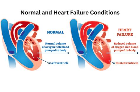 What Is Heart Failure Cause Symptoms And Treatment