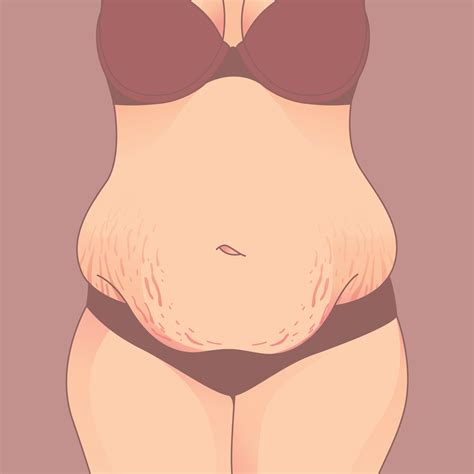 Belly With Stretch Marks Saggy Skin Removal Woman Body Shape