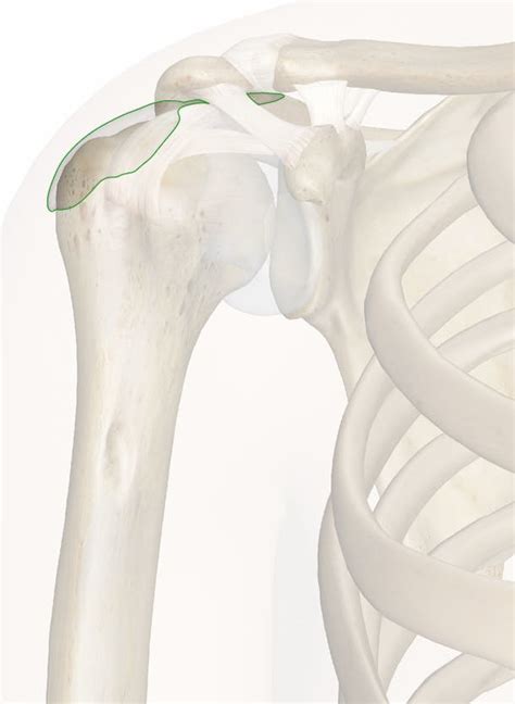 Subdeltoid Bursitis Shoulder