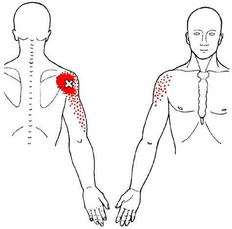 Deltoid Trigger Points And Referred Pain Patterns