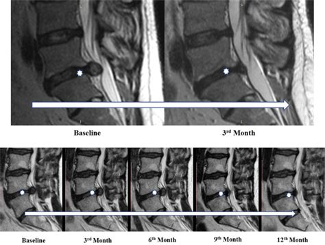 Prediction Of Lumbar Disc Herniation Resorption In Symptomatic Patients