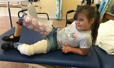 9yo Takes Her First Steps After Having Leg Amputated Seven Years Ago