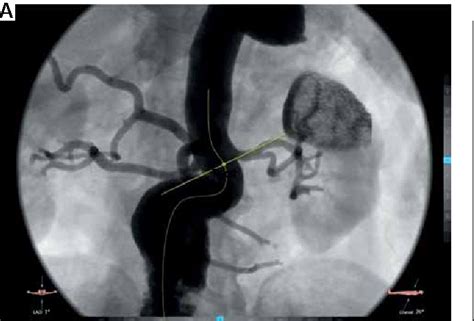 Figure 1 From Predeployed Aortic Extension Cuff Kilt In Evar With